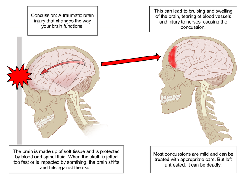 Mild Traumatic Brain Injuries